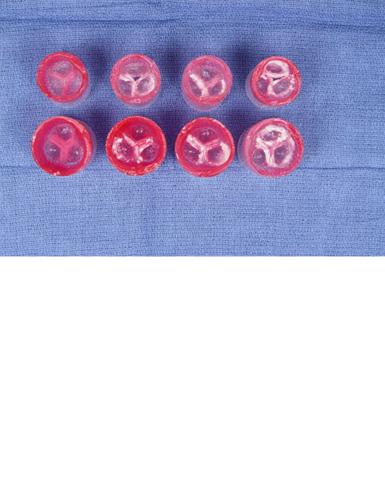 Healthy and calcified (light, med, heavy) aortic valves with annulus sizes: 20, 23, 26 and 29mm